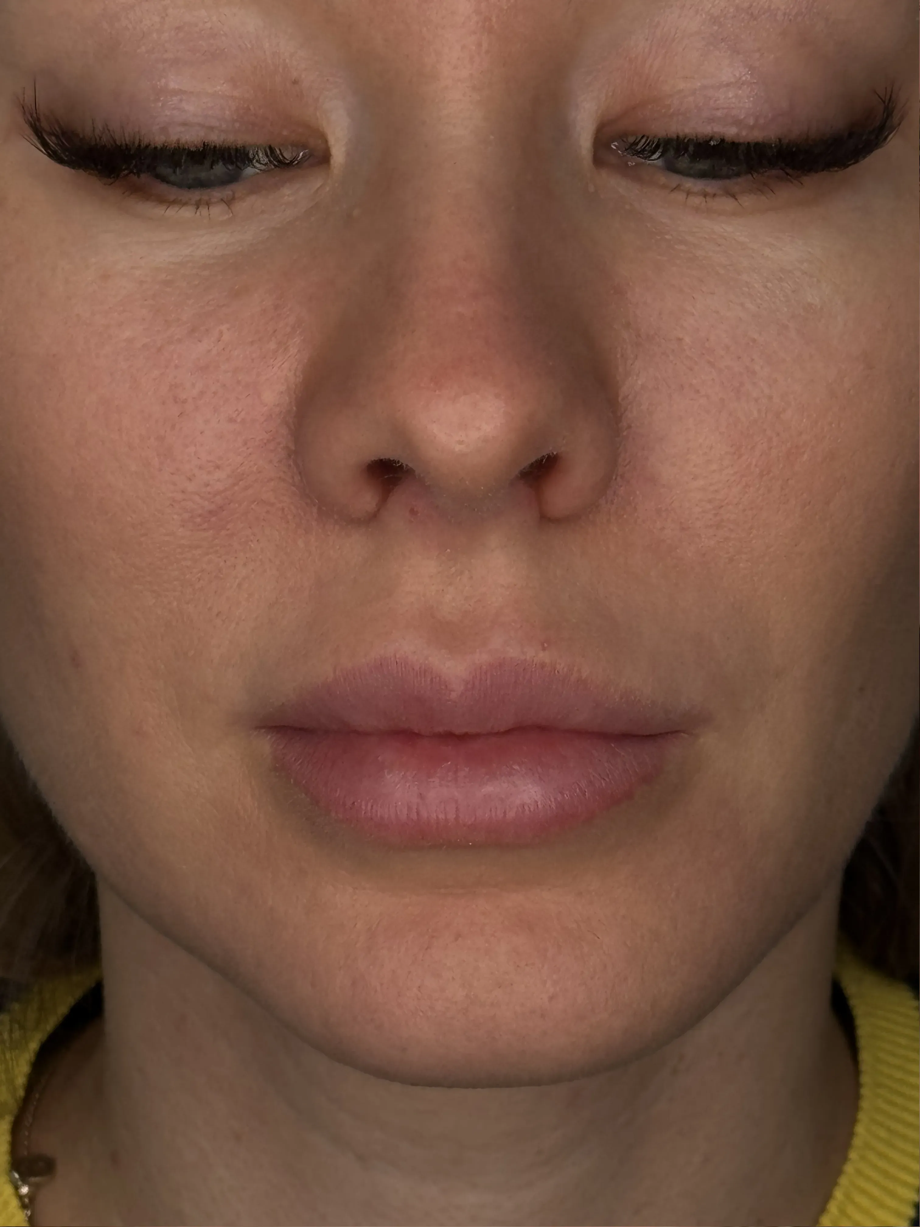 Nachher Lippen